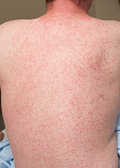 an adult with the measles rash all over their back