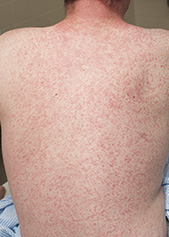 Measles Including Symptoms Treatment And Prevention SA Health   Measles Rash Prof Da%235FBCD9 